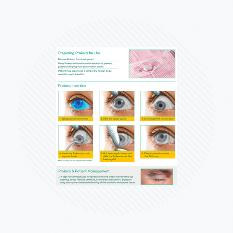 A step-by-step guide on using BioTissues Prokera Amniotic Membranes, featuring images and text instructions for eye prep, anesthesia application, Prokera placement, and patient management to support regenerative healing.