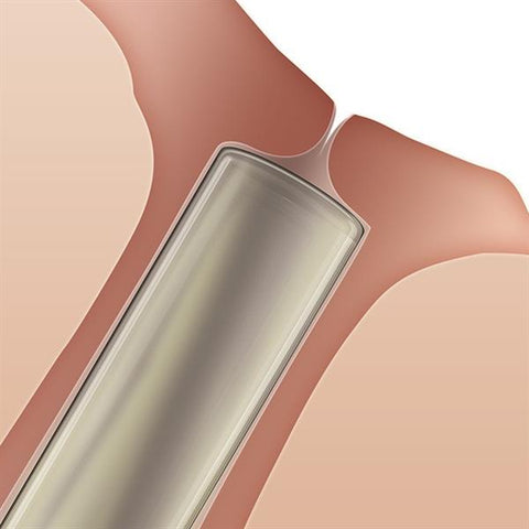 Oasis SOFT PLUG Collagen Intracanallcular Plugs (60pack) 3 Sizes